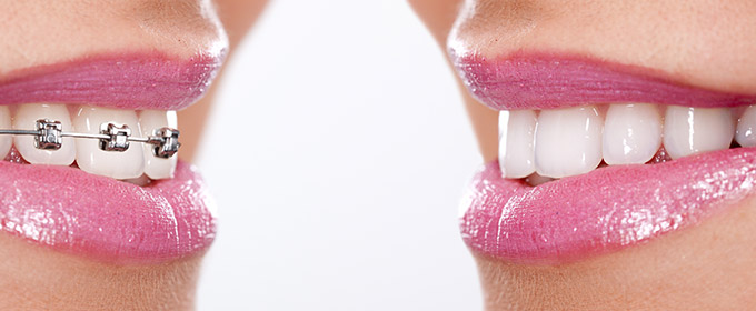 Zahnspange in Backnang für Erwachsene – „unsichtbare“ Zahnkorrektur